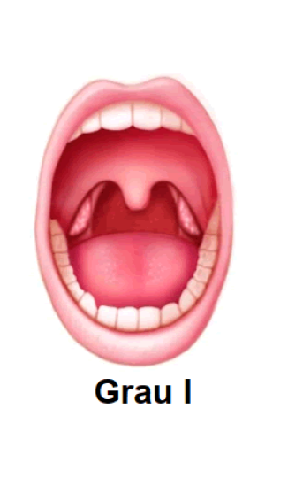 Tonsila Grau I
