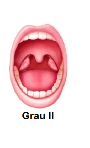 Tonsila Grau II