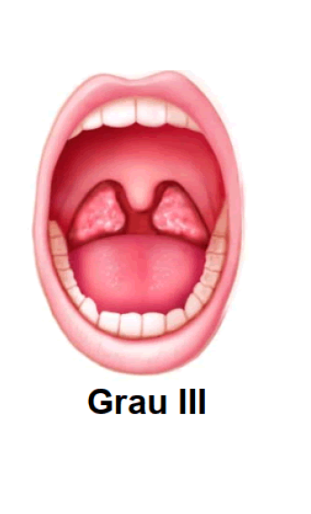 Tonsila Grau III
