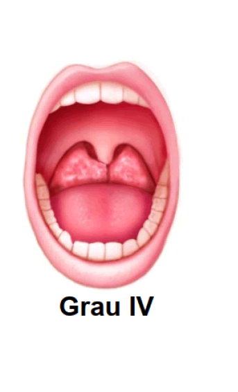 Tonsila Grau IV